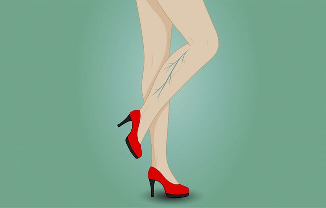 Varicosis veins in a woman's legs