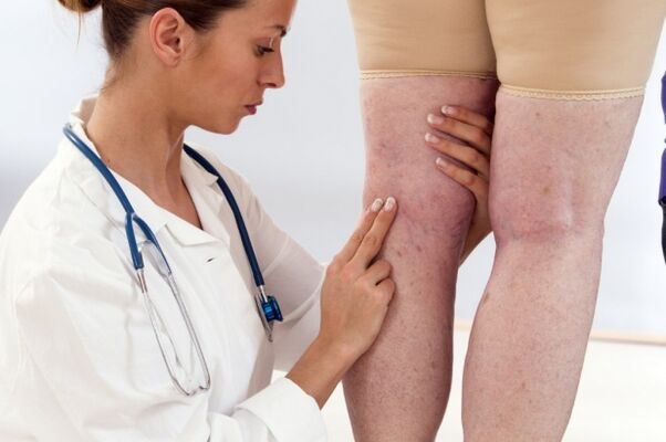 Therapy of Varicosis Veins in Women