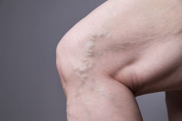 Varicosis veins in women
