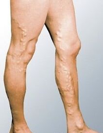 Varicose veins in a person's legs