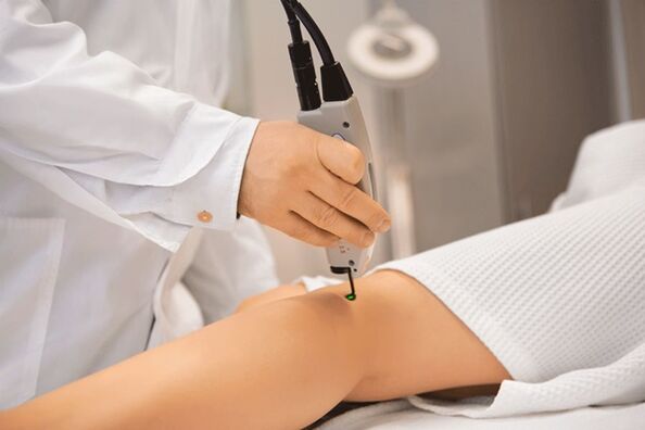 Laser coagulation of the veins of the lower extremities
