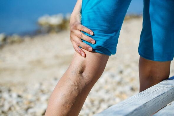 Painful pain in the legs with varicose veins