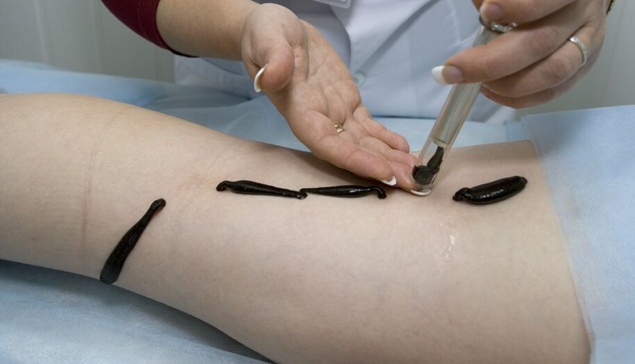 treatment of varicose veins with leech