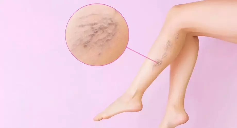 Curved bulging veins in legs with varicose veins