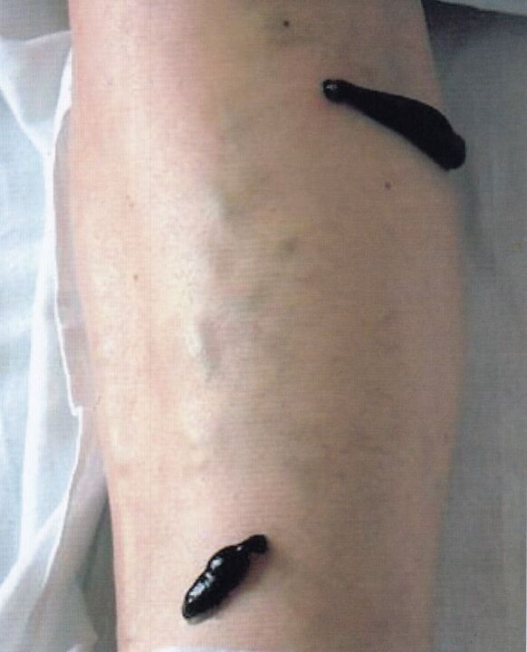 Hirudotherapy - treatment of varicose veins in the legs with leeches